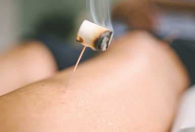 Moxibustion (Moxa)